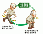 脊柱管狭窄症